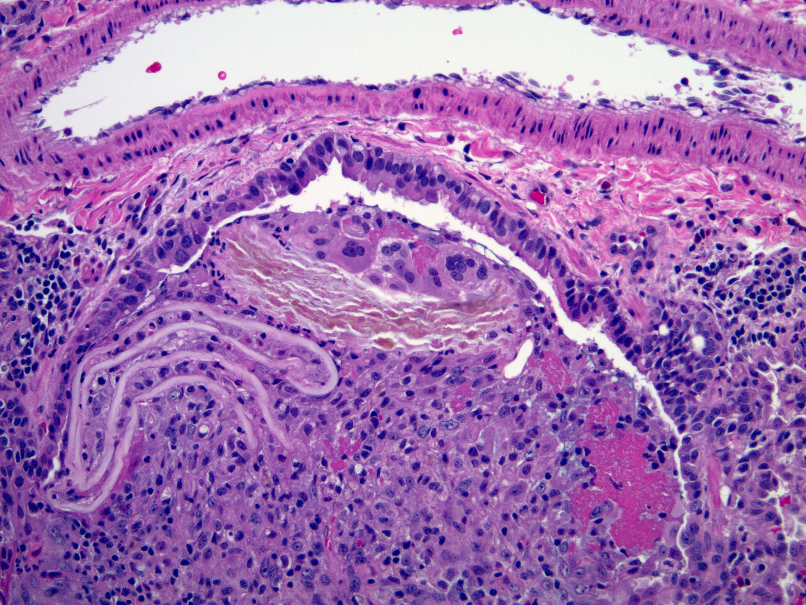 Aspirated food particles are pathognomonic KiKo XP