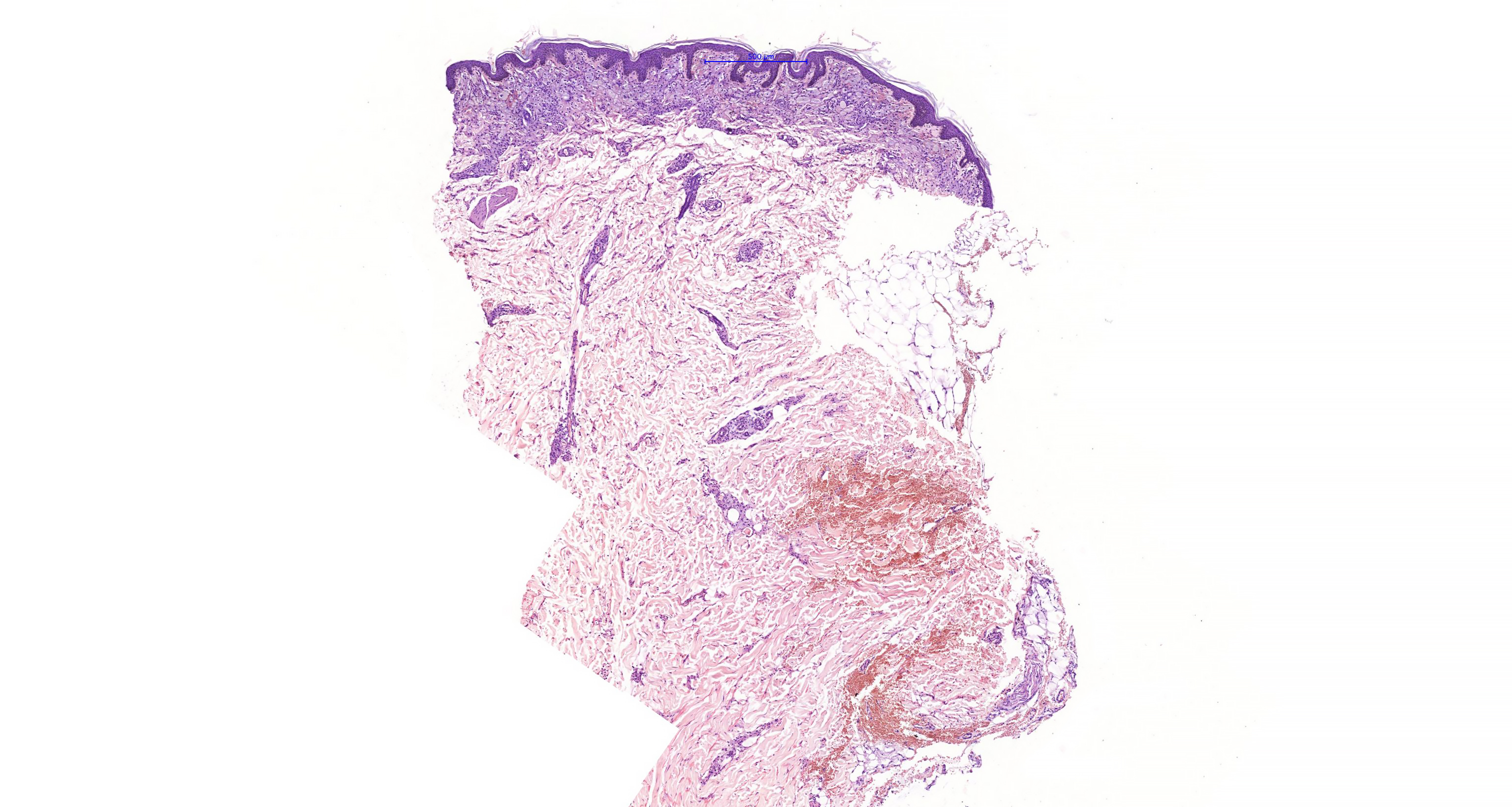 Generalized diffuse plane xanthoma KiKo XP