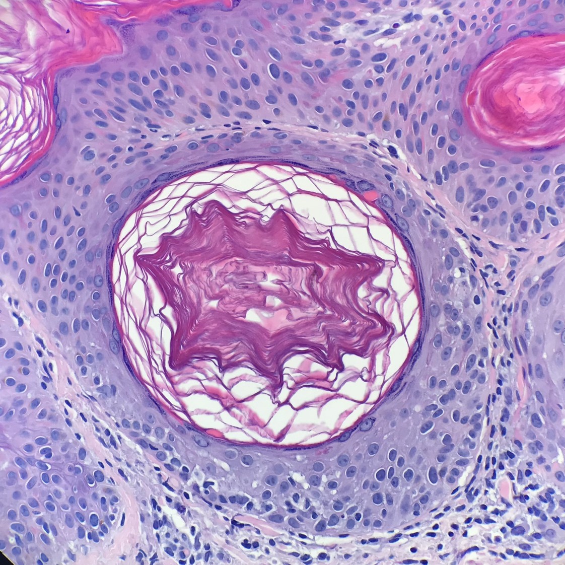 Horn pseudocyst in a seborrheic keratosis KiKo XP