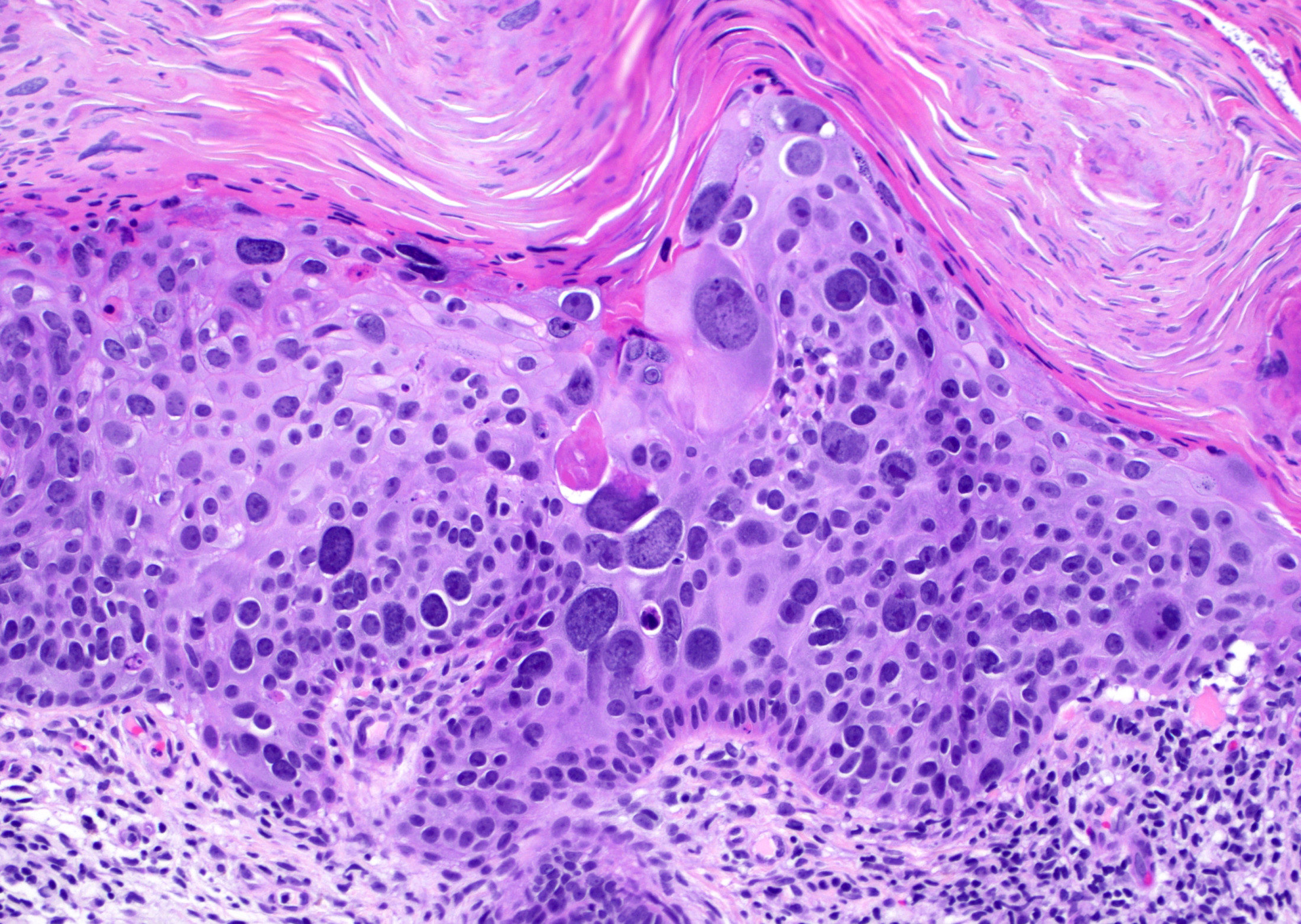 squamous-cell-carcinoma-in-situ-bowen-s-disease-with-massive