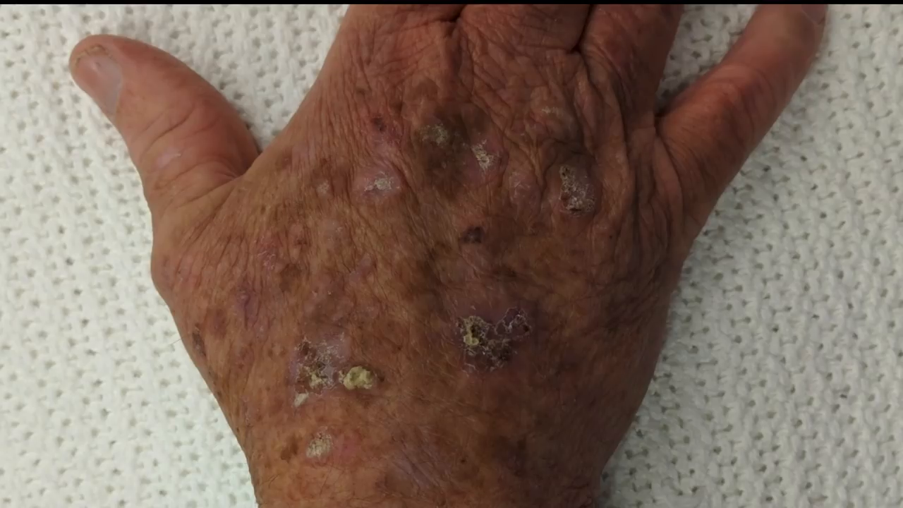 Cutaneous Horn Everything You Need to Know (video) KiKo XP