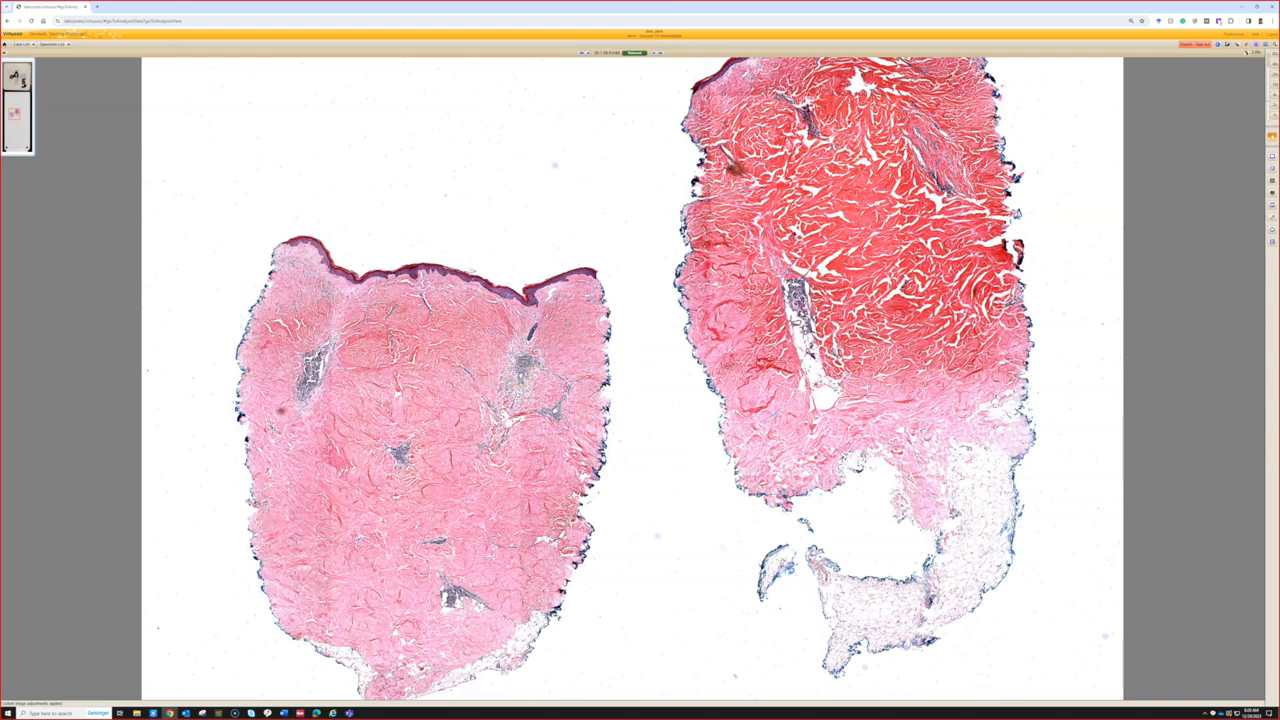 Morphea Skin Disease Histopathology