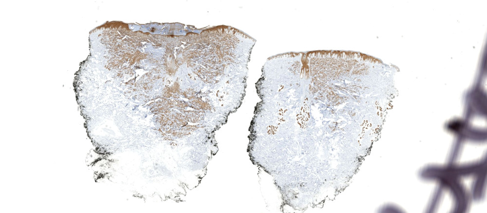 Case 3 65 Yo Woman With Annular Plaque On Left Side IHC KiKo XP