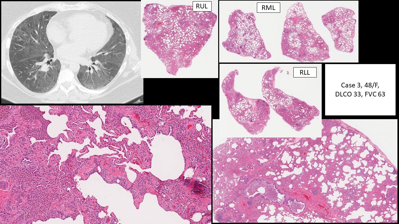 Smokingrelated interstitial fibrosis (SRIF) case 3 of the study/paper by Vehar S et al KiKo XP