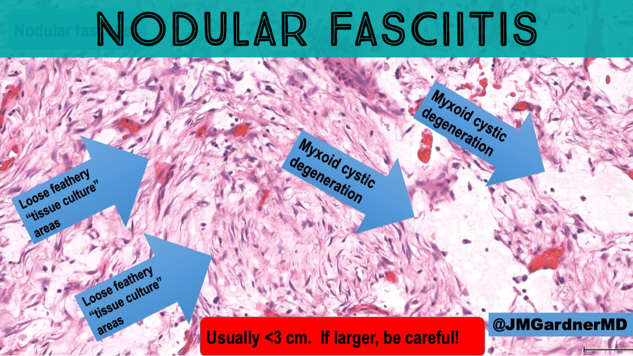 Nodular fasciitis 101 tips & tricks for diagnosis (video) KiKo XP