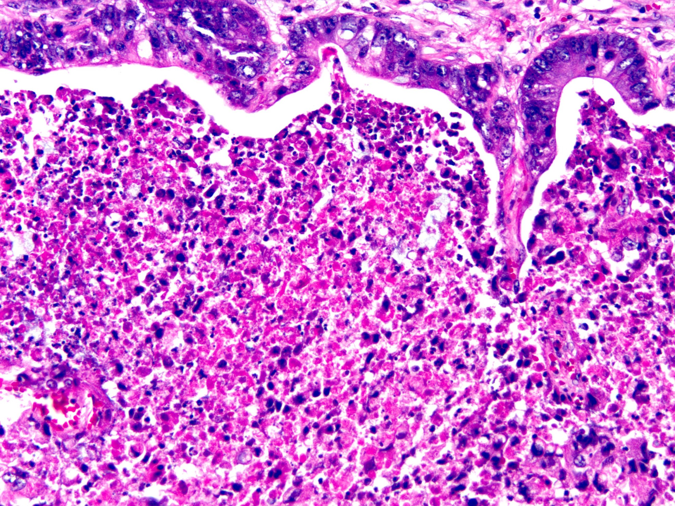 Dirty Necrosis In Colorectal Carcinoma KiKo XP