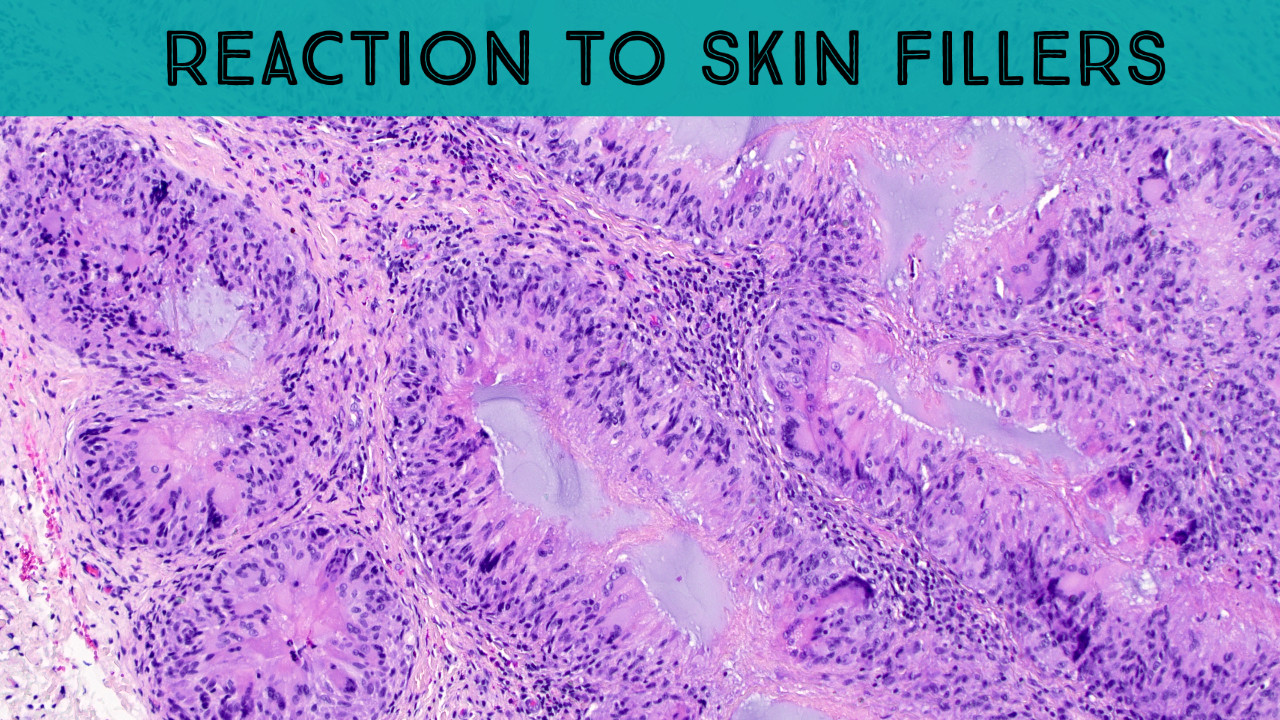 Reaction to Skin Fillers (Hyaluronic acid lip filler with palisaded