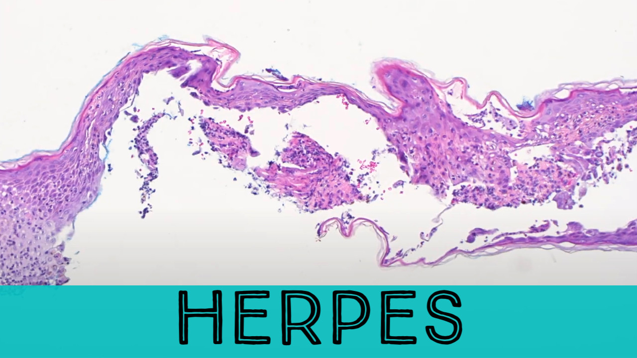 Temporary Relief From Herpes