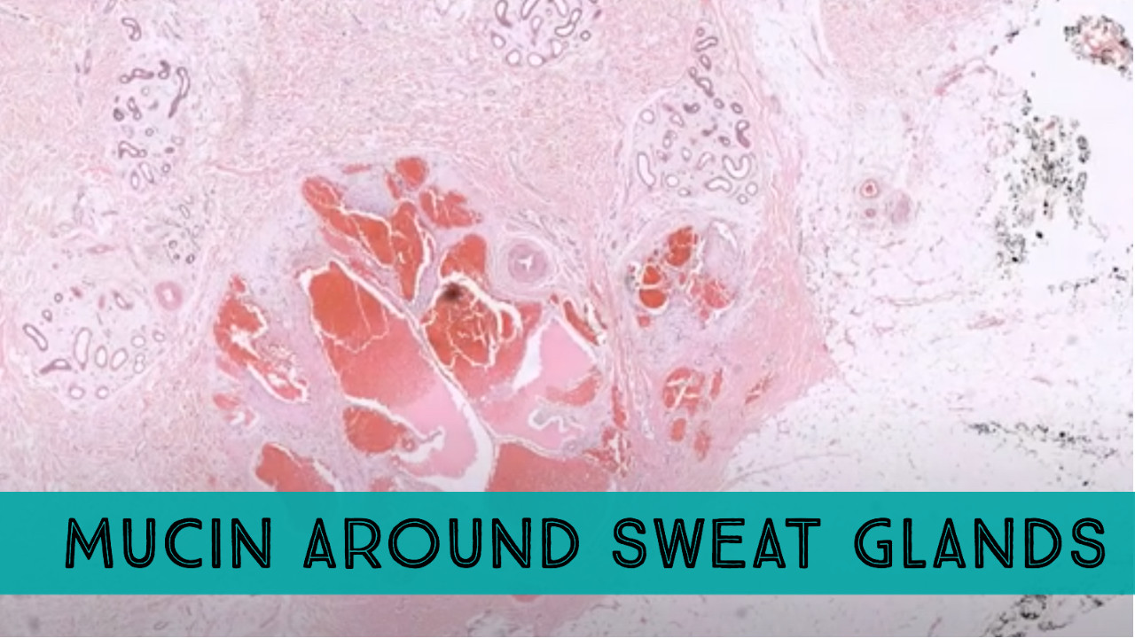Mucin/Myxoid change around sweat glands/eccrine coils what does it