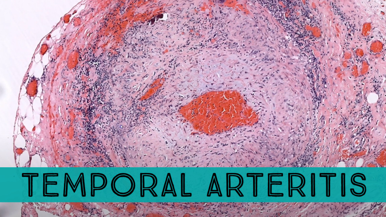 Temporal arteritis (giant cell arteritis) under the microscope