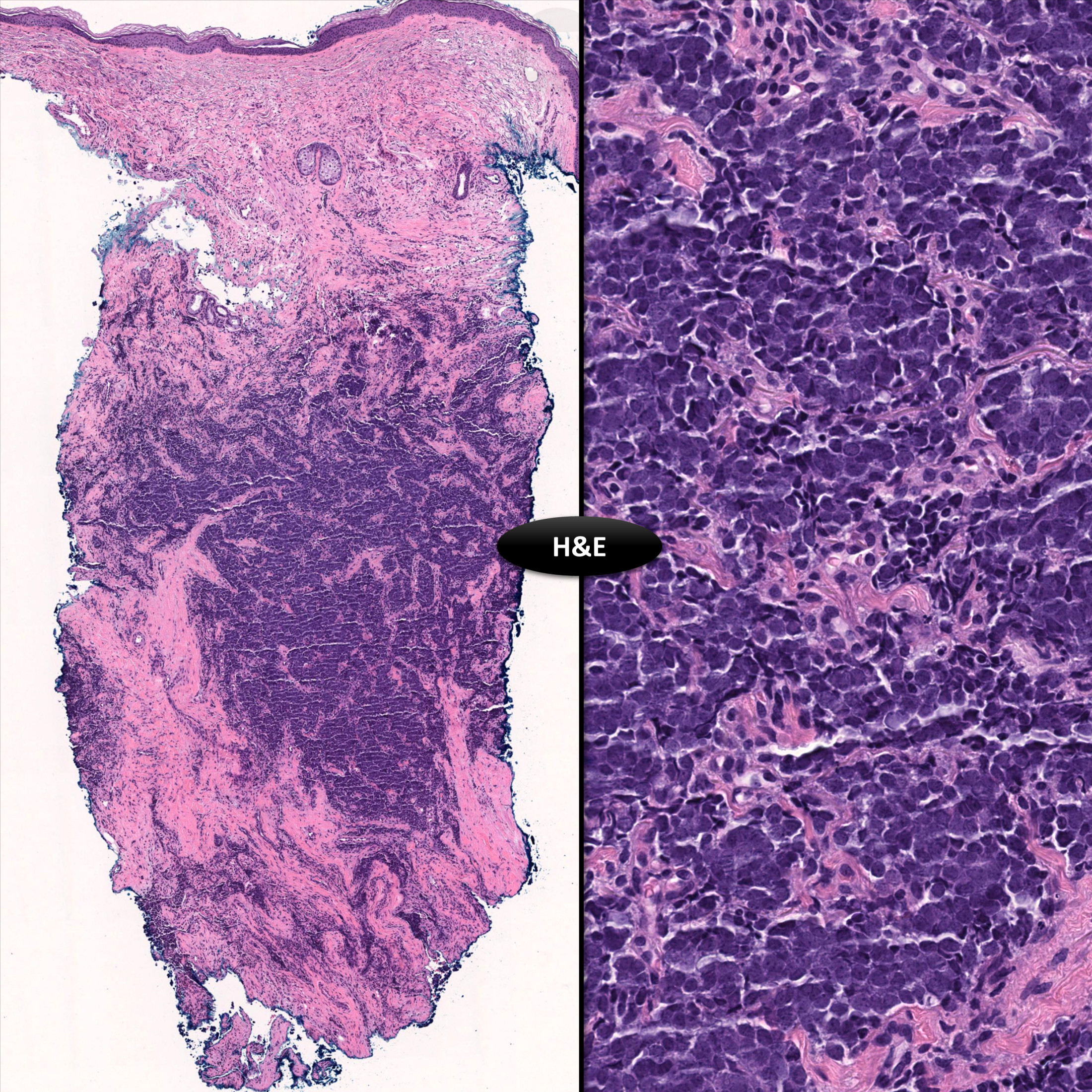 Cutaneous Small Blue Cell Tumor Kiko Xp
