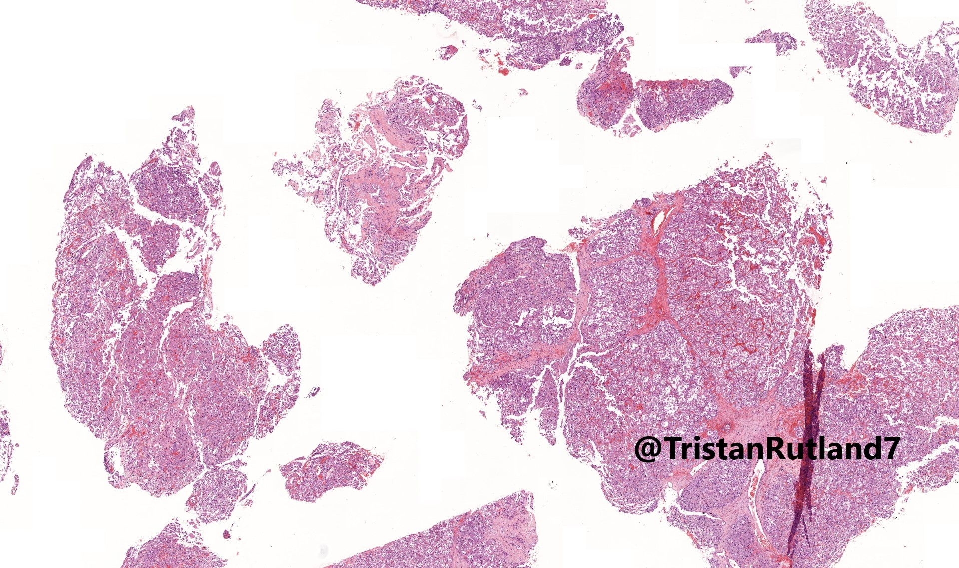 What Is Metastatic Alveolar Soft Part Sarcoma