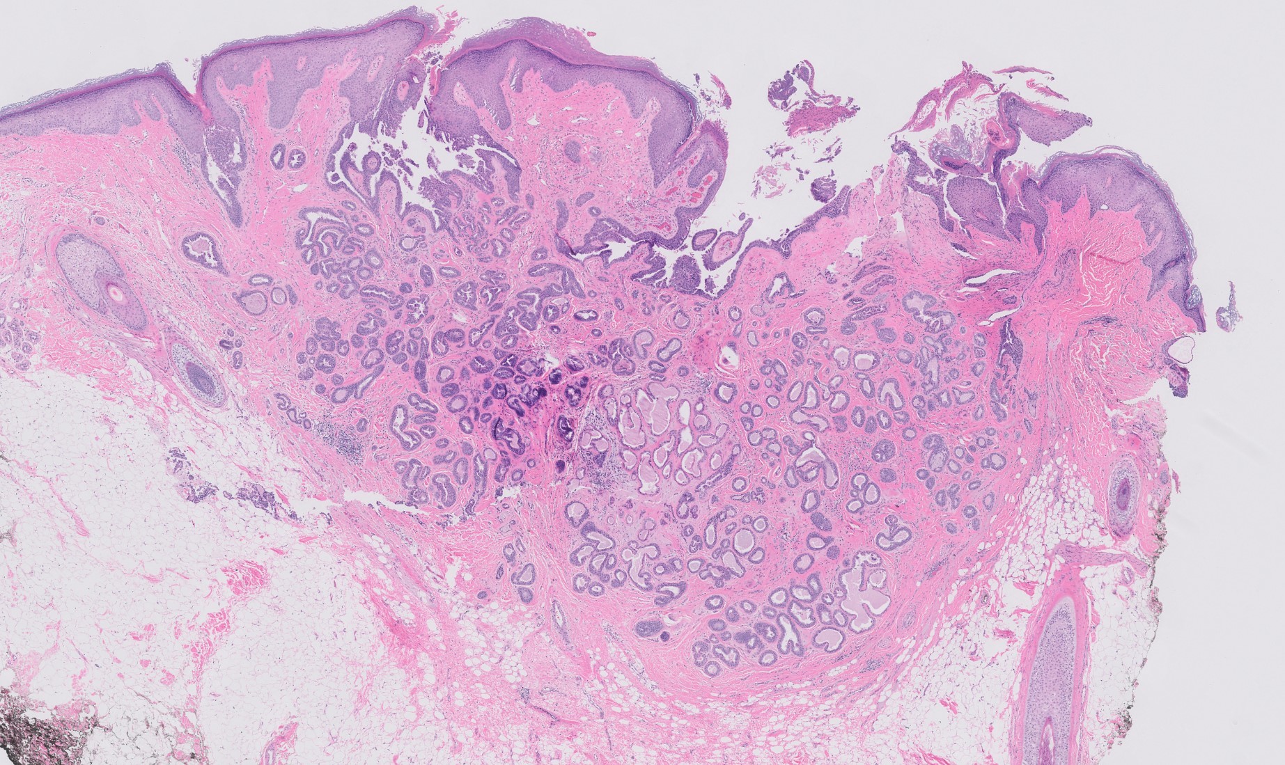 Tubular apocrine adenoma with epidermal connection kiko xp