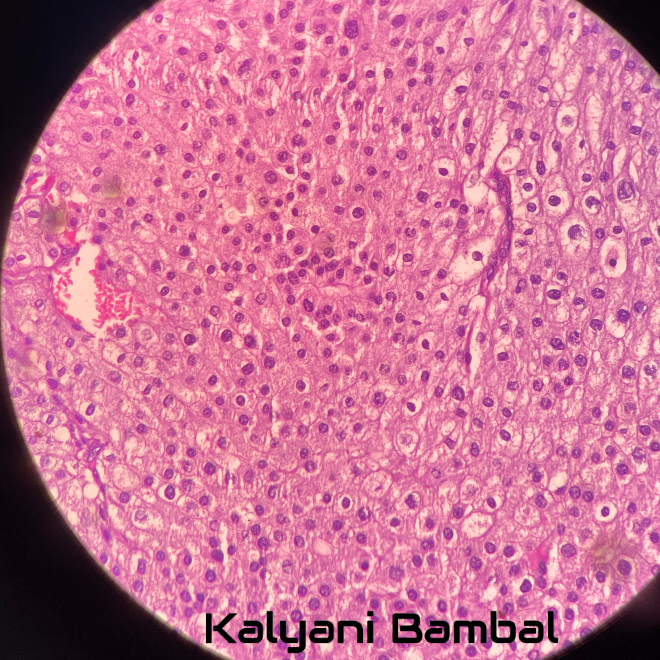 a-53-year-old-man-with-hematuria-kiko-xp